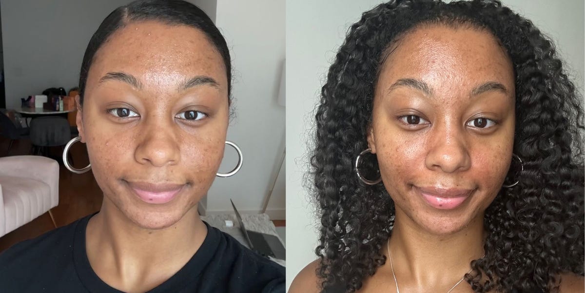 I Tried Skin Flooding for Acne—The Results Shocked Me